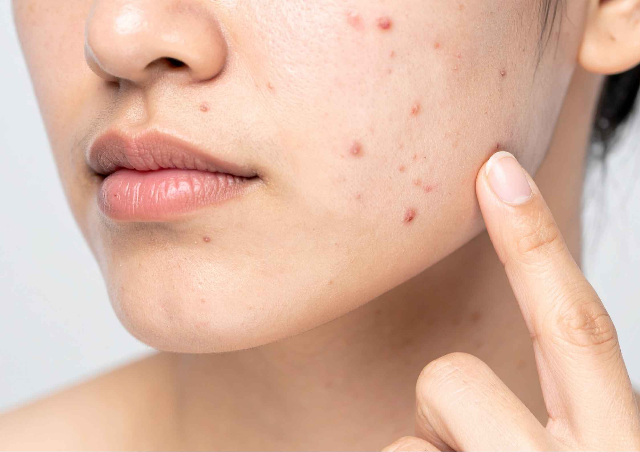 Kenapa Begadang Bisa Memicu Jerawat Hormonal? Ini Penjelasannya